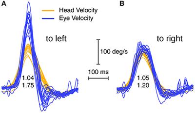 Enhanced Eye Velocity in Head Impulse Testing—A Possible Indicator of Endolymphatic Hydrops